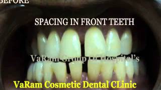 preview picture of video 'Space Closure-VaRam Dental Virudhunagar'