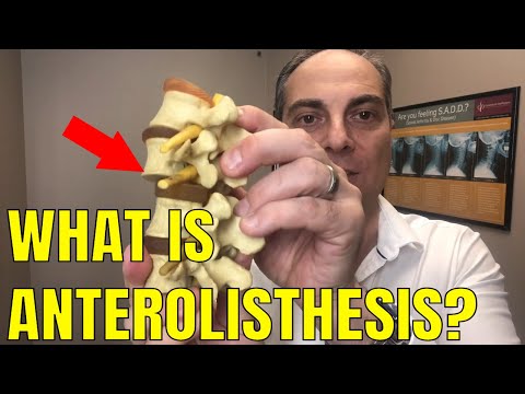 Ep61. What Does Anterolisthesis Of L5 Mean? | Dr. Walter Salubro Chiropractor in Vaughan