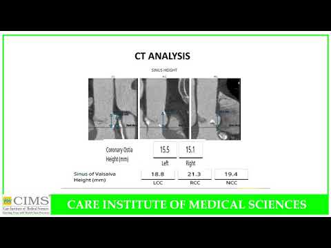 Dyeless TAVI / TAVR in Patient with severe AS, AR & MS/MR