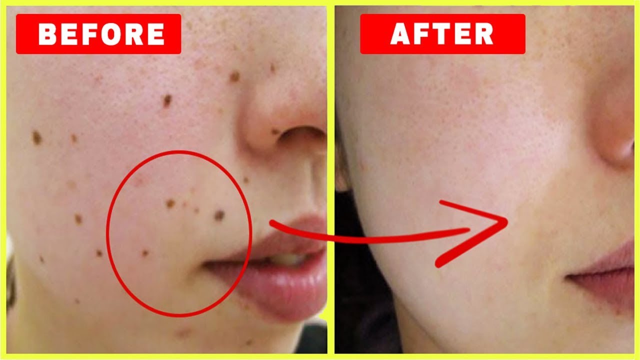 Til Hatane Ki Cream Aur Anya Gharelu Upay