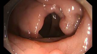 Download lagu EMR under Colonoscopy Aohua Endoscopy System AQ-100 mp3