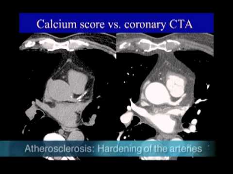 UCSF Radiology: Calcium Scoring vs. Coronary CTA Scan