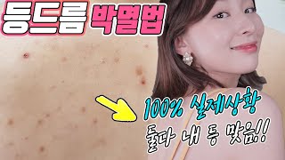 등드름 진짜 없애는 법! 100% 셀프관리법,관리Q&A(바디로션써도돼요?색소침착 어떻게?) 비포애프터🎉 광고X 약X 피부과X