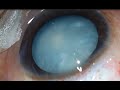 Intumescent White Cataract In A Young Patient Management HD (Unedited)