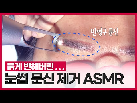 눈썹 문신제거 레이저 ASMR. 피코 레이저로 눈썹 한 올도 태우지 않고 망한 눈썹문신 지워보자!