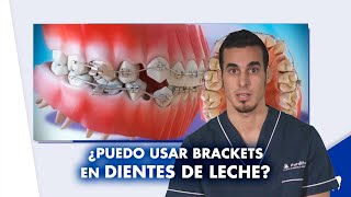 Solo tengo UN DIENTE TORCIDO: ¿necesito usar BRACKETS ¿Y si es diente de leche | #Shorts