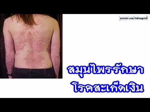 มีอาการคันที่แข็งแกร่งของโรคสะเก็ดเงิน การฉีดวัคซีนโรคผิวหนังภูมิแพ้