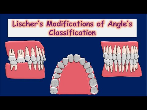 Lischer's Modification of Angle's Classification | Classification of Malocclusion