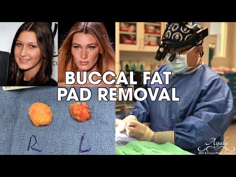 BUCCAL FAT PAD REMOVAL