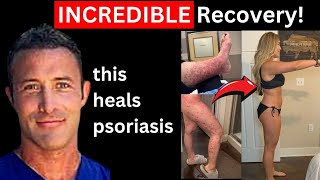 #1 Psoriasis Treatment! | Jen Geissert