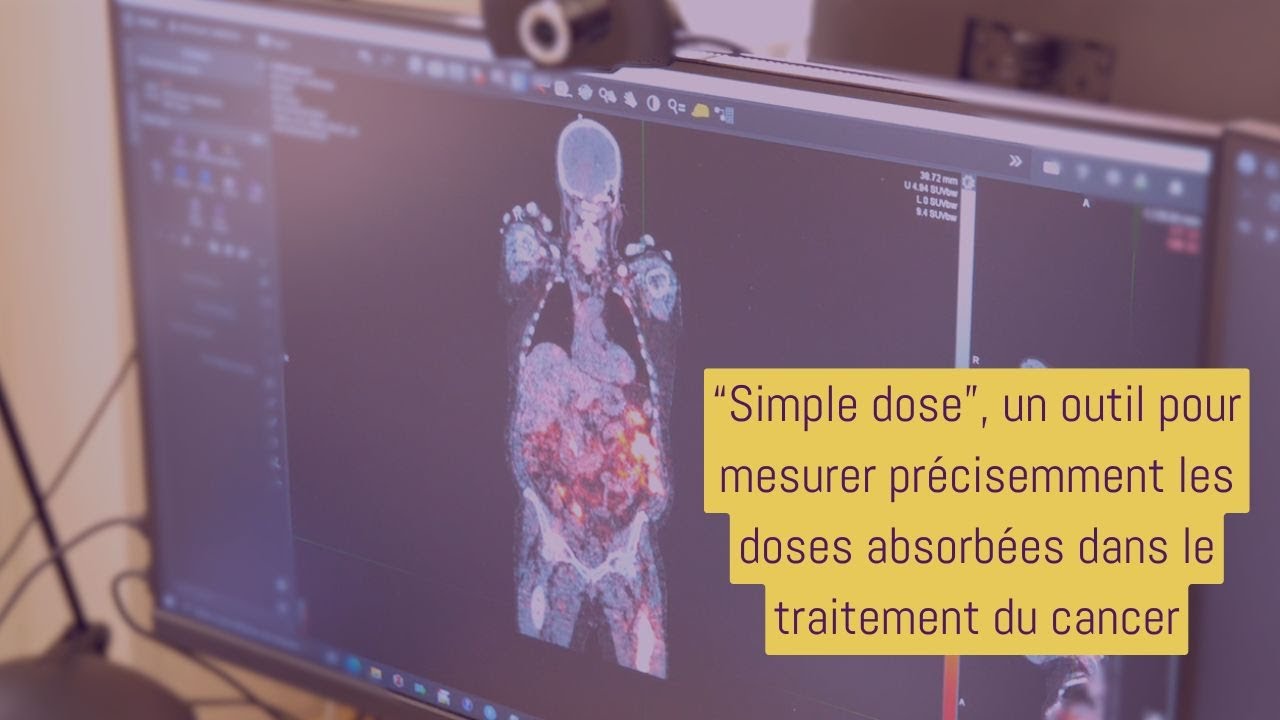 "Simple dose" : un outil pour mesurer précisemment les doses absorbées dans le traitement du cancer