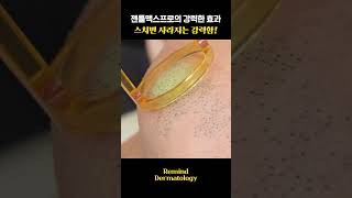 레이저 제모 성형 시술