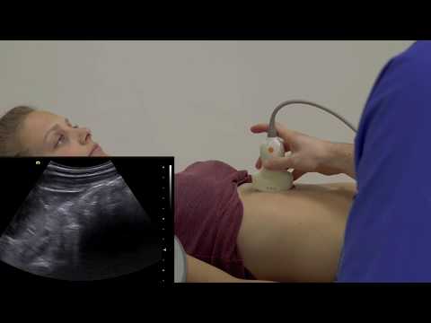 Abdomensonografie - Aorta