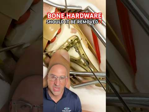 Should Bone Plates & Screws Be Removed⁉️ #shorts