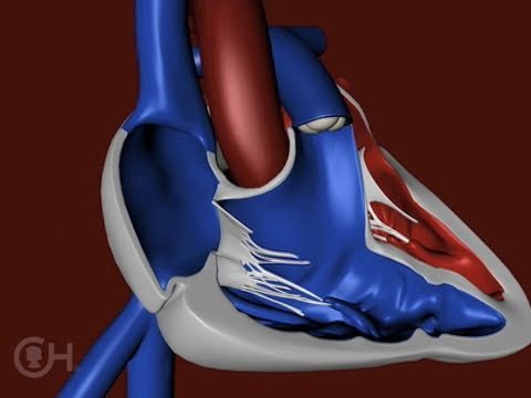 The Structure of a Heart with Tetralogy of Fallot (TOF) - The Children's Hospital of Philadelphia