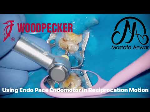 How to Manage Inflamed Pulp? Using WOODPECKER “Endo Pace” Endomotor | Reciprocation | Intrapulpal