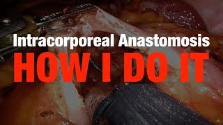 Download Lagu Robotic Ileocolic Intracorporeal Anastomosis, My Preferred Method Thumbnail