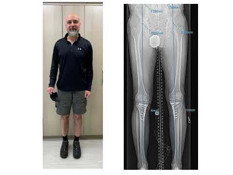 Image - Bowleg Surgery for Knee Arthritis