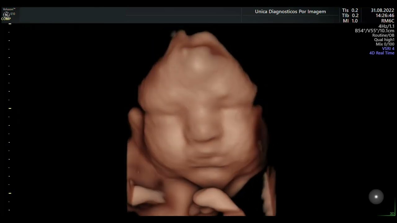 Ultrassom 4D HD Live - 12