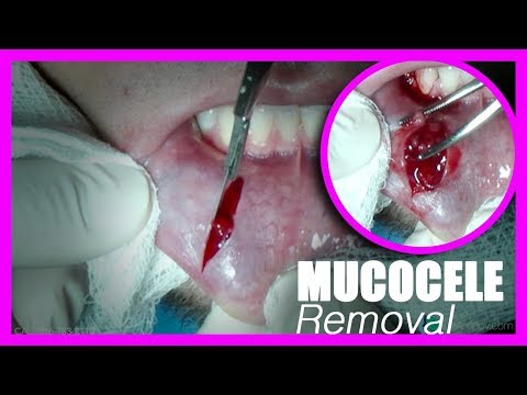 Mucocele Extraction