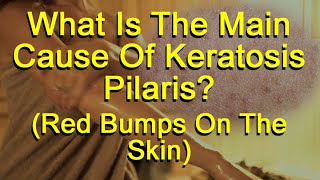 What Is The Main Cause Of Keratosis Pilaris (Red Bumps On The Skin)?