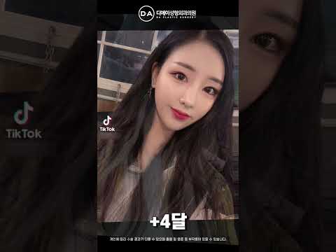 미니리프팅+코성형