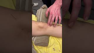 How to Treat Knee Pain with Dry Needling | IAOMM Course UK