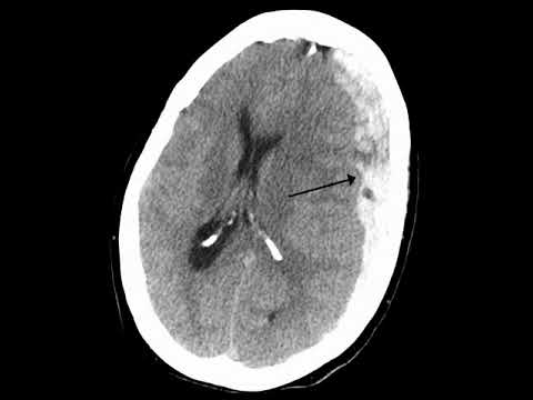 Podcast # 335: Blunt Head Trauma