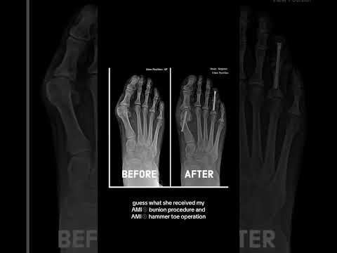 Are Your Bunions Killing You? Foot Transformation.