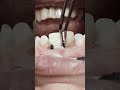 Removing retraction cord after RCT and composite restoration for anterior teeth #satisfying