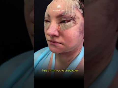 Сложная реабилитация по дням у пациентки после смас подтяжки лица #фейслифтинг