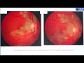 AIOC2024  IC144 Topic  Dr Vishali Gupta Pigmentary fundus with uveitis How to proceed