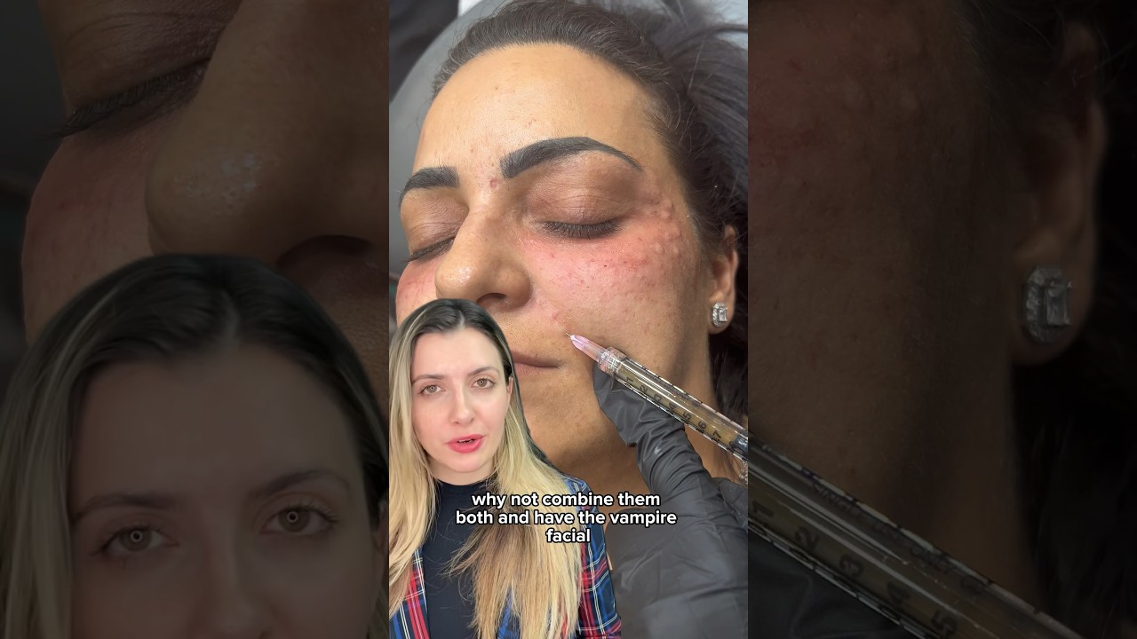 PRP MICRONEEDLING VS. PRP INJECTION | Dr. Medispa