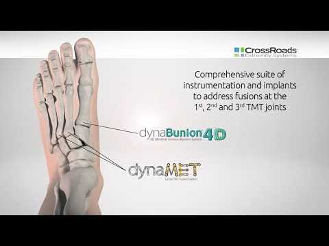 The Power of DynaBunion® Now for LESSER TMT Fusions - Introducing dynaMet™ Coming June 22nd