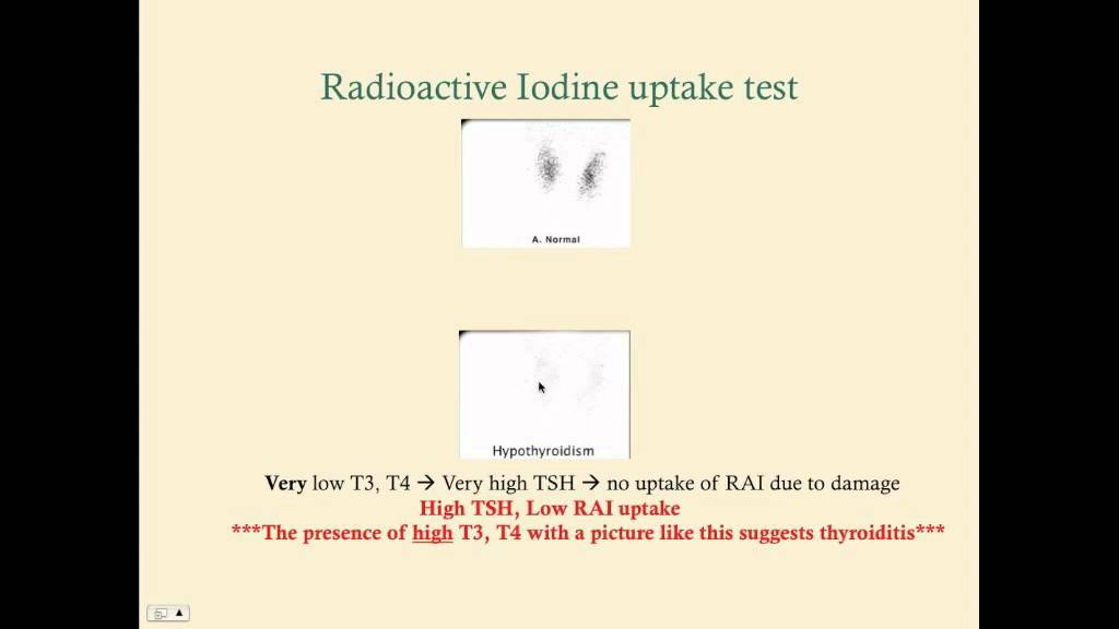 Thyroiditis - CRASH! Medical Review Series - YouTube