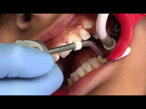 Klejenie zamków ortodontycznych - część 2