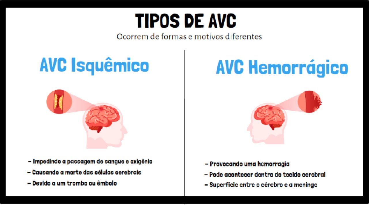 O que é AVC, AVE, Derrame Cerebral | Tratamento, Diagnóstico, Prevenção