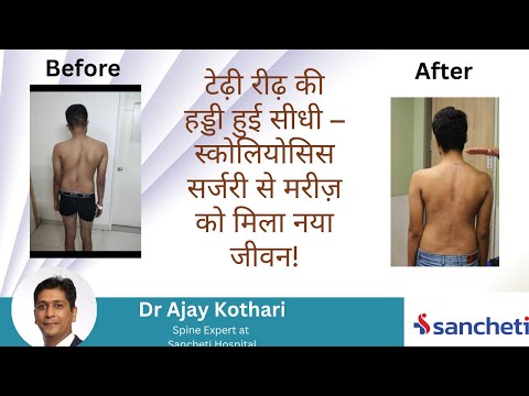 स्कोलियोसिस सर्जरी से मिला नया जीवन | Dr. Ajay Kothari