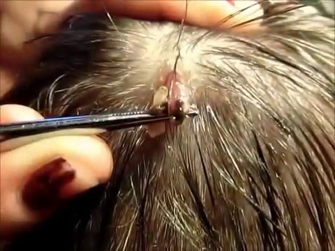 Parassiti di una cavità orale Le migliori targhe da vermi per la gente
