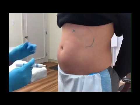 CoolSculpting in South Jersey