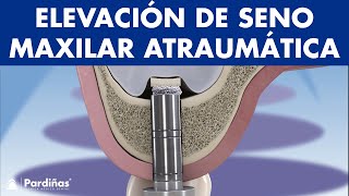 Elevación de seno ATRAUMÁTICA o TRANSCRESTAL - Colocación de IMPLANTES para pacientes SIN HUESO ©
