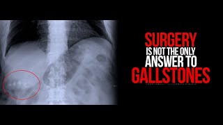 preview picture of video 'TESTIMONIAL Video Gallbladder stone removed without surgery cholelithesis permanent treatment'