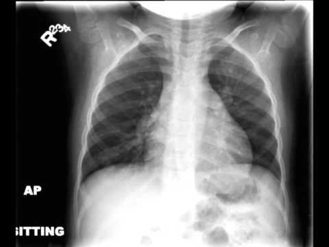 Chest X ray Child