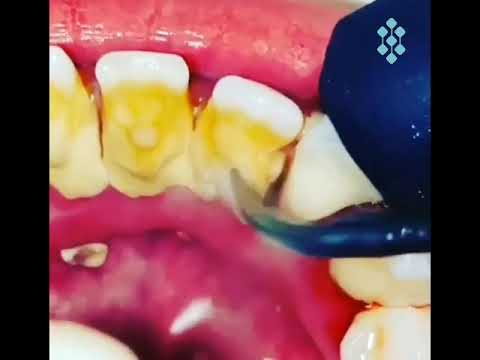 Limpieza Dental de Sarro Con Ultrasonido Piezoelectrico
