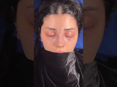 Rhinoplasty in Turkey | Dr. Umut Erdoğan