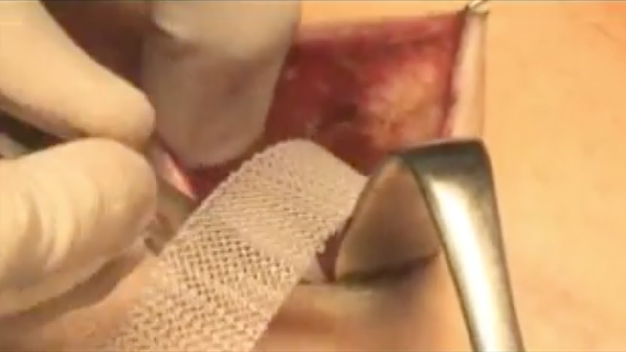 Umbilical Hernia - repair using mesh