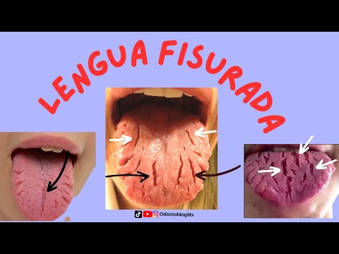 Lengua fisurada ó lengua escrotal