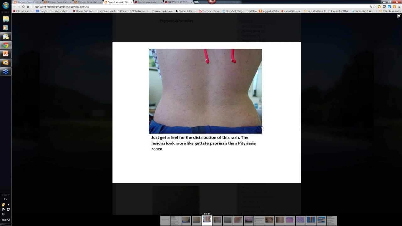 201305-19 14.58 Consultations Pityriasis Lichenoides - YouTube