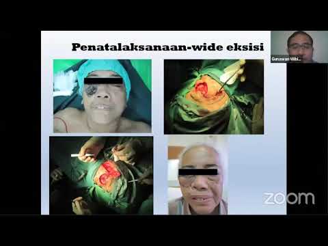 Webinar Awam: Waspada Kanker Kulit