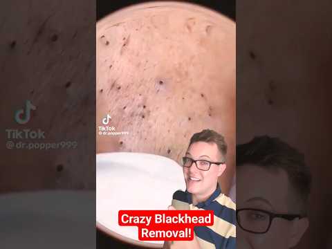 Crazy Satisfying BLACKHEAD REMOVAL #shorts